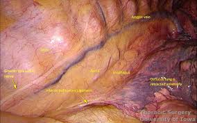 A single incision is made from the chest to the abdomen on the left side, and an incision is made in the neck. Esophagectomy Three Field Mckeown Laparotomy And Right Thoracoscopy Thoracotomy With Cervical Anastomosis Iowa Head And Neck Protocols