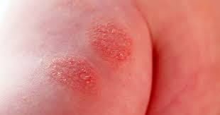 Image result for vyrážka u dětí