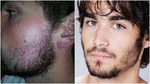 Using either soft wax, which is pulled off with cloth strips, or hard wax that simply hardens and is pulled off on its own, a practitioner can remove hairs from your upper lip, cheeks, brows, and. How To Grow Facial Hair On Your Cheeks Beardstyle