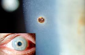 Image result for Eye Foreign Body