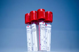 Swabbing is unnecessary in today's medical world. Which Stds Can Be Checked With A Blood Test