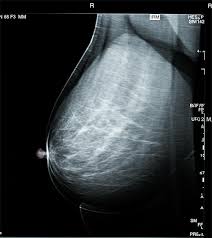Image result for Mammogram Interpretation