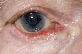 Two other students keep getting grossed out at them. Ectropion Nhs