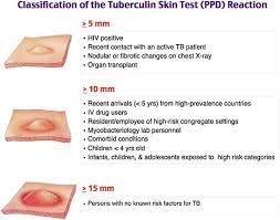 The tb skin test, also known as the mantoux tuberculin skin test, is the most common way doctors diagnose tuberculosis. Tag Someone Who Needs To Know This Do Not Look At The Area Of Erythema Look
