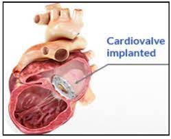 Transcatheter Solutions For The Tricuspid Valve Cardiac Interventions Today