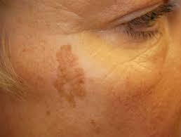Lentigo simplex is not induced by sun exposure, and it is not associated with any medical diseases or conditions. Solar Lentigo Dermnet Nz