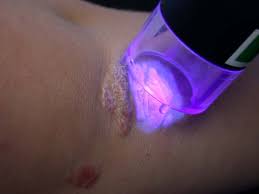 Excimer And Pulsed Light Therapy For Scalp Psoriasis