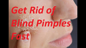 How to get rid of a lip pimple fast. How To Get Rid Of Blind Pimples Quickly And Naturally Remove Blind Pimple Youtube