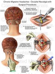 Chronic Migraine Headaches Occipital Neuralgia With Surgical Procedures Occipital Neuralgia Neuralgia Hemiplegic Migraine