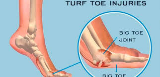 Turf toe is a sprain of the fibrous joint capsule that supports the metatarsophalangeal (mtp) joint at the base of the big toe. What Is A Turf Toe Injury About Turf Toe