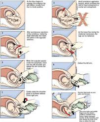 Image result for Breech Delivery