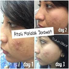 Trulum skin care (jujur tanpa rekayasa). Trulum 5ml 15ml 120ml Penghilang Jerawat Dan Bekas Jerawat Shopee Indonesia