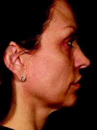 Before & After Cosmetic Treatments West Orange NJ