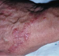 Image result for Rhus Dermatitis