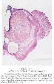 P16 (additionally referred to as cyclindependent kinase inhibitor 2a, more than one tumor suppressor 1 and as several. Pathology Outlines Mesothelioma