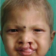 Affected members of family 2 with various clinical associations of lip...