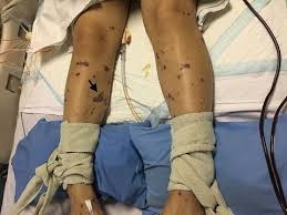 Myokarditis Bei Fulminanter Meningokokkeninfektion Youtube