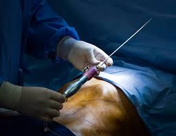 In order to know the cost, we need to understand the elements that make up a website and attach costs to each of them. Is It Safe To Do Liposuction In Nigeria Skin101 Center