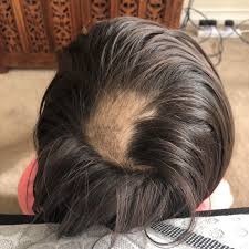 Hair loss is a common problem especially among young adults. Cureus Combined Diet And Supplementation Therapy Resolves Alopecia Areata In A Paediatric Patient A Case Study