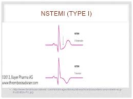 Under the current stemi vs nstemi paradigm, almost 1/3 rd of nstemi patients have unrecognized acute total occlusion (omi) discovered on delayed angiograms. Acute Coronary Syndrome Update Charles Shoalmire Msn Rn