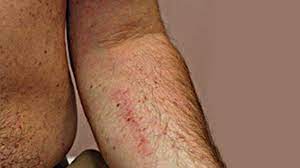 Signs of cancer in the intestines include unexplained weight loss, weakness, reduced appetite, persistent abdomen pain and blood in the stools. Leukemia Rash Pictures Symptoms And When To See A Doctor