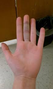 Jammed Finger From Basketball My Own Finger 0 O Jammed Finger Jam Finger
