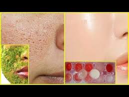 Gozenek Sikilastirici Maske Acik Gozenekler Icin Buz Uygulamasi Guzellik Bakim Youtube Guzellik Maskeler Youtube
