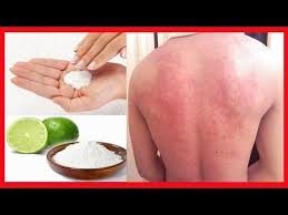 elimine qualquer tipo de alergias com este tratamento natural facil de fazer youtube tratamentos naturais alergias alergia na pele