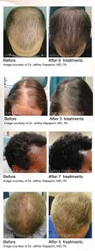 While clinical studies have been carried out for several years and have suggested that prp therapy is effective with different growth factors, many dermatologists have only recently begun to try it in their practices. Prp Hair Restoration Mesohealth