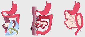 Image result for Intestinal Malrotation