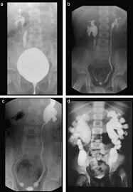 Image result for Pediatric Reflux