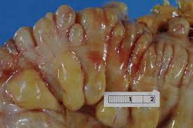 Diverticulitis Wikipedia