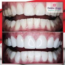 Dengan veneer gigi, gigi kamu akan dilapisi oleh porselen pada bagian depan. Dokter Anggi Dental Clinic Paket Veneer Composite 20 Gigi Terbaru Agustus 2021 Harga Murah Kualitas Terjamin Blibli