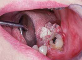 Doctors and dentists usually find oral cancer during routine checkups. Oral Cancer Images The Oral Cancer Foundation