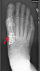 Fremdmaterial Schrauben Platten Ogam Orthopadie