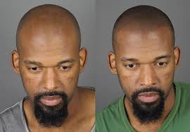 At natural enhancement we offer hair tattooing treatments for both men and women, whether the hair loss is due to ageing, accidents or other medical conditions. Hair Tattoo What Is Scalp Micropigmentation Cost Before After Pics