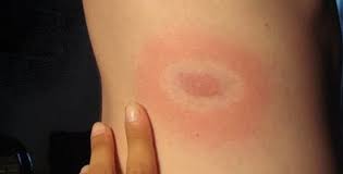 Slike kako prepoznati jelenskega klopa. Bolesti Koze Uzrokovane Borrelijama Zdravlje