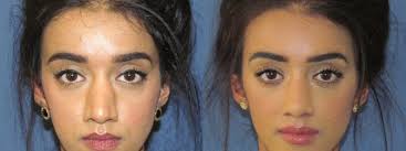 These images are an essential part of your nasal assessment and medical record. Ethnic Rhinoplasty In London Mr Ivo Gwanmesia