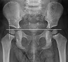 Image result for Hip XRay