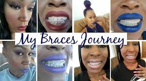 Compare all the dentists and contact the braces clinic in nogales, mexico that's right for you. Carvlog I Didn T Want To Go To Mexico 500 Braces 15 Youtube