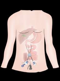 Read about gastric bypass weight loss surgery available at our houston, texas practice. Single Incision Laparoscopic Sleeve Surgery Sils Tijuana Mexico Baja Ca Dr Sergio Verboonen