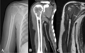 Mesh Patch And Anchors Can Improve Clinical Results Of Prosthetic Replacement After Resection Of Primary Proximal Humerus Malignant Tumor Scientific Reports
