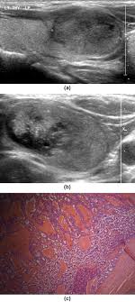 Radiological Pathological Correlation Of The British Thyroid Association Ultrasound Classification Of Thyroid Nodules A Real World Validation Study Clinical Radiology