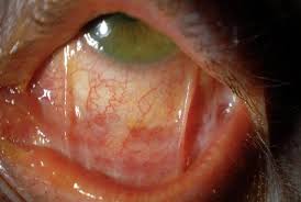 Image result for Pemphigoid