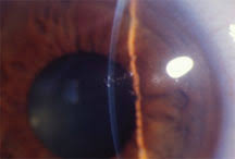 There are three major categories (some doctors use four). Eyeworld Updates On Abmd