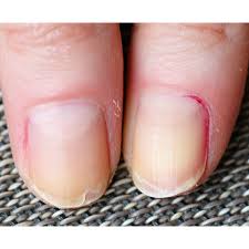 二枚爪の予防法】乾燥シーズンこそ多発！二枚爪の基本知識と７つの予防法【二枚爪・ささくれとさよならする方法！】｜美容メディアVOCE（ヴォーチェ）