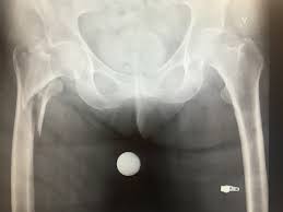 En ugunstig vridning i hoften når man går hos yngre mennesker med normalt benvev, skal det store krefter til for å brekke lårhalsen. Hoftebrudd Store Medisinske Leksikon