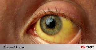 Check spelling or type a new query. Penyakit Kuning Gejala Penyebab Obat Dan Pencegahan