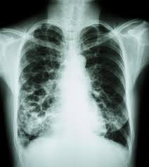 Can doctors wrongly diagnose cancer? Study Finds Evidence That The Presence Of Emphysema On A Ct Scan Increases Lung Cancer Risk