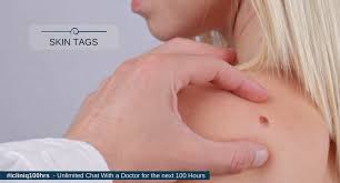 They occur when veins protrude externally and blood gathers within the externally protruding veins. Skin Tags Acrochordon Causes And Treatment
